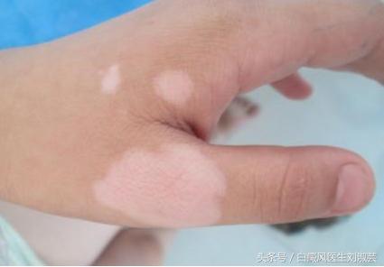 白癜风医生给出3点用药建议,白癜风医生开的激素药