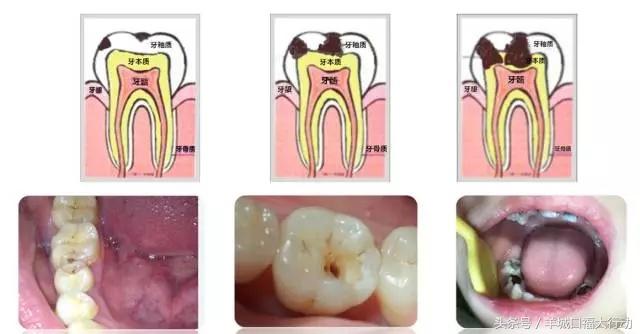龋齿蛀牙有虫吗,科普蛀牙的形成