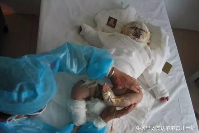 父母必修课：宝宝烫伤烧伤怎么办？