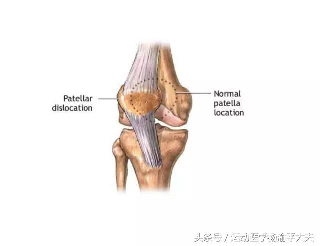习惯性髌骨脱位微创手术,髌骨习惯性脱位手术刀疤