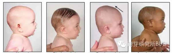 宝宝偏头莫担忧预防纠正有妙招,宝宝偏头的最佳治疗方法