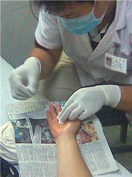 拇指弹响治疗方法,拇指腱鞘炎弹响最快的恢复方法