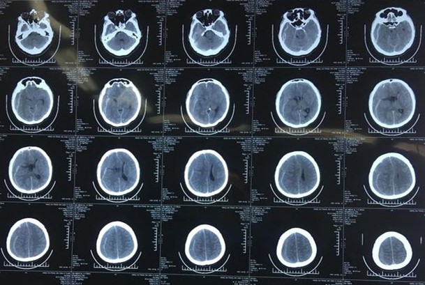 心脏抗凝期出血怎么办,心脏血肿手术