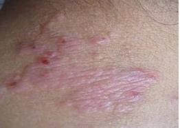 情绪不好出现皮肤病,情绪不稳定得皮肤病