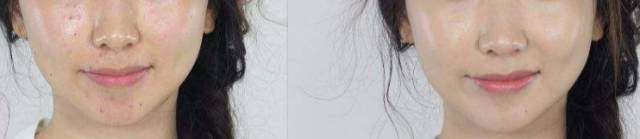 如何通过化妆遮掉脸上的痘印斑点？