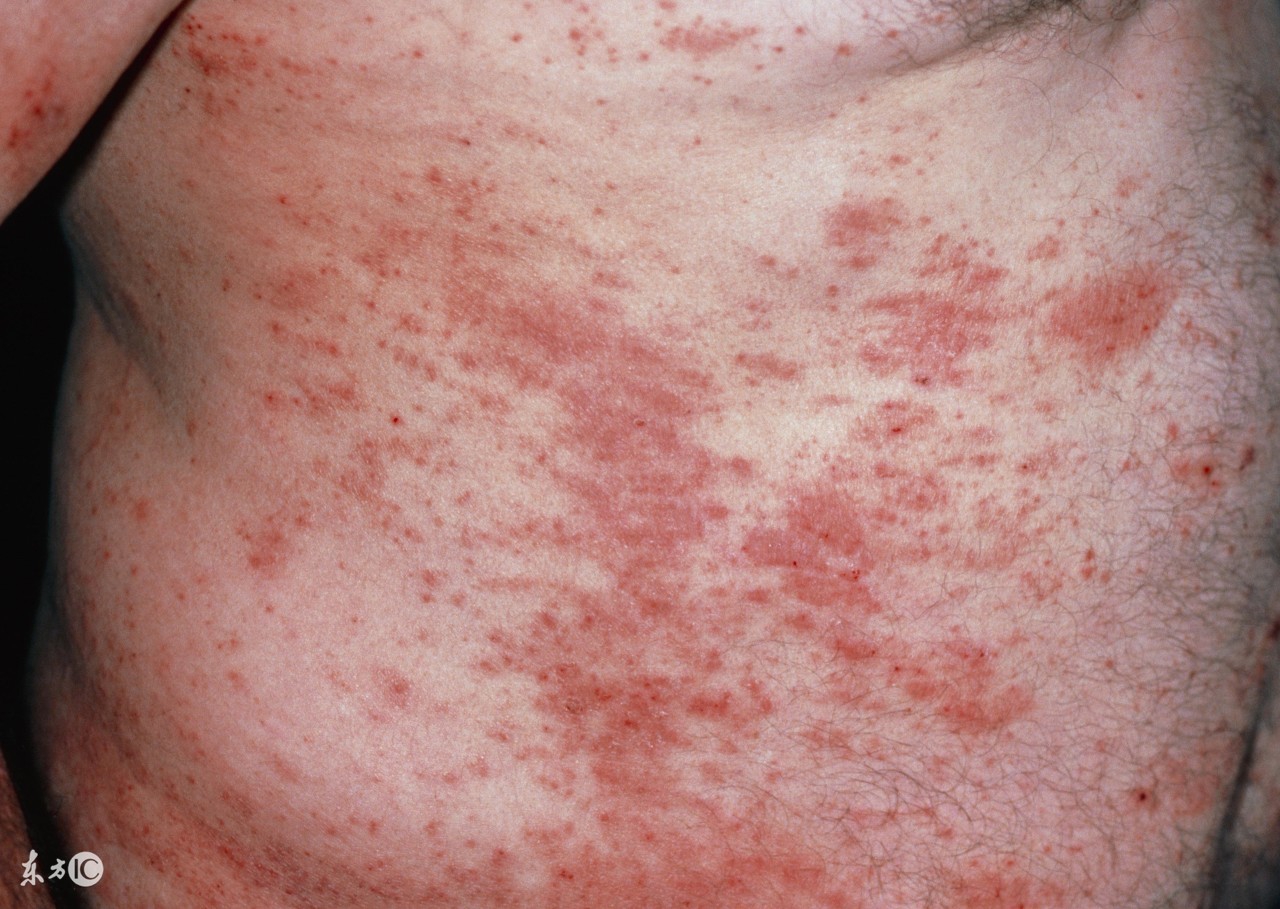 治疗湿疹调理体质,急性湿疹如何辨证论治