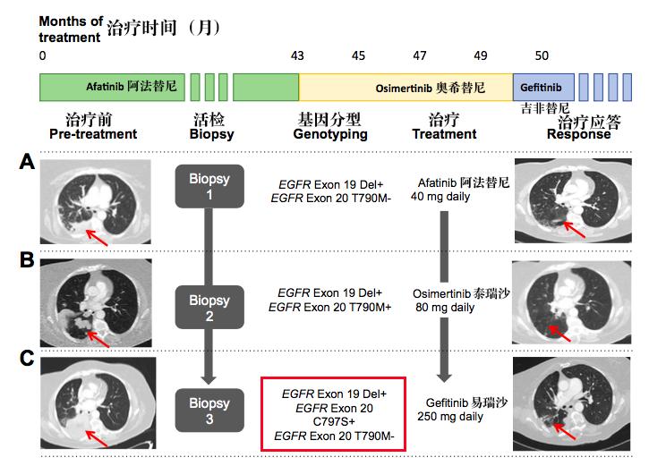 案例：奥希替尼（AZD9291）耐药后用回吉非替尼有效！
