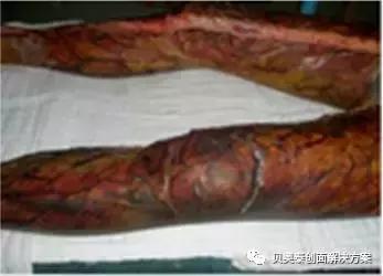 烧伤的治疗,烧伤的治疗土方