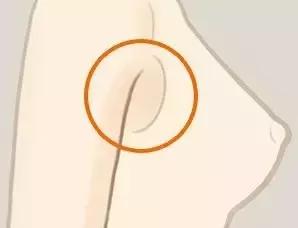 腋下两团赘肉是副乳吗,怎么消除副乳腋下肉