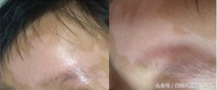 白癜风在治疗过程中白斑变红,身上长了白癜风怎么治疗