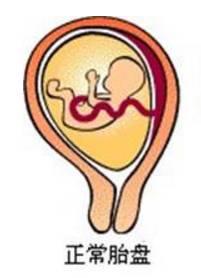 孕晚期前置胎盘一定会大出血吗,前置胎盘29周见红是什么情况