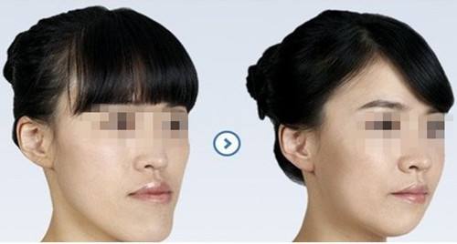 深圳地包天透明牙套厂家,深圳天包地隐形牙套多少钱