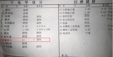 尿蛋白就一定是肾病吗,出现尿蛋白就是得肾病吗