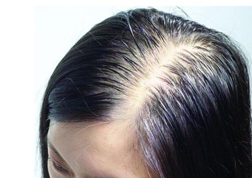 头发里的白色颗粒是脂溢性脱发吗,头痒抠出的黄泥是什么