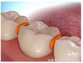 牙齿矫正过程中个别牙齿一碰就疼,牙齿矫正过程中牙缝大是正常的吗