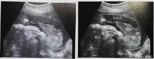 胎盘早剥诊断ppt,胎盘早剥的诊断与护理试题