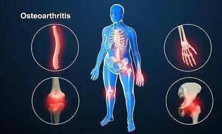 骨关节炎最新诊疗指南,骨关节炎医院排名