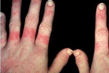 红斑狼疮这样记忆治疗,想不懂都难!