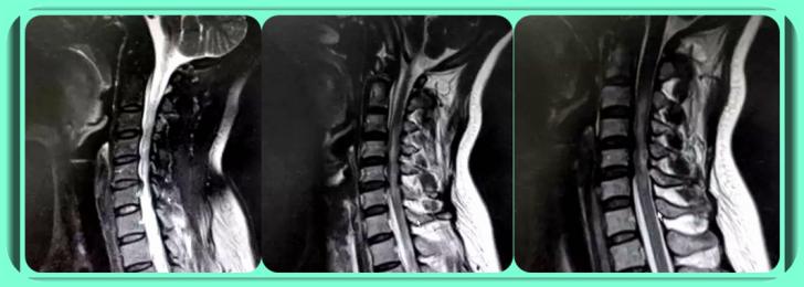 颈椎管狭窄到0.9严重吗,请问专家颈椎管狭窄怎么锻炼