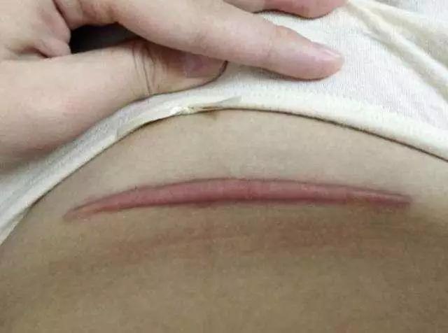 剖腹产后伤口24天化脓,剖腹产伤口有个小洞流脓多久好