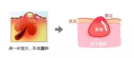 痘痘闭口摸起来软软的,痘痘摸上去硬硬反反复复