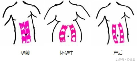腹直肌分离怎么紧实肚子上的肉,腹直肌的运动疗法是什么