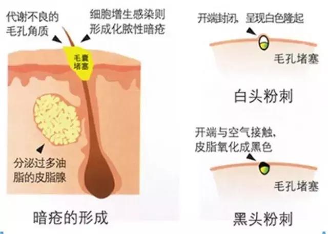 痘痘闭口摸起来软软的,痘痘摸上去硬硬反反复复