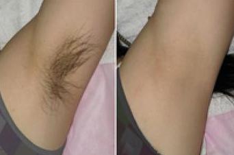 狐臭手术2021价目表,做狐臭手术需要多少费用