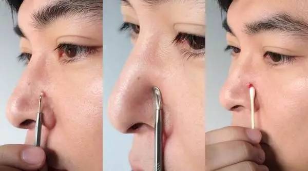 自己在家怎么正确挤痘痘,教你如何挤痘