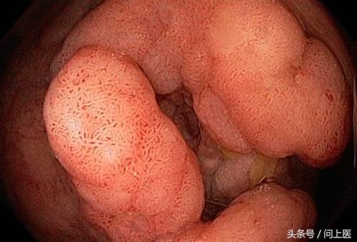 溃疡性结肠炎初期症状及治疗,溃疡性结肠炎症状最新治疗方法