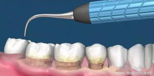 洗牙之后牙缝变大一吃肉就塞牙,洗牙后可以戴牙套防止牙缝变大么