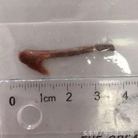 咳嗽几十年原来肺里进异物了,35岁男人长期咳嗽