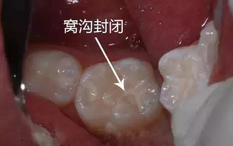 牙齿缝隙有黑的怎样去掉,幼儿的牙齿有黑污垢怎么去掉