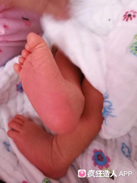 开指太痛特想用力怎么办？