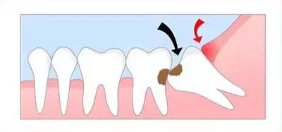 长智齿但是不能拔牙怎么办,长的智齿发炎了最好的解决办法