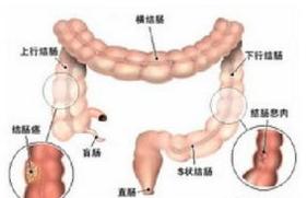 肠癌手术后腹胀腹痛怎么回事,肠癌患者出现腹胀后如何治疗