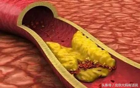 脑动脉硬化白发,白发跟心脑血管疾病有关系吗