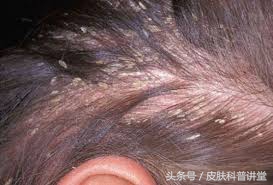 西医认为脂溢性皮炎的原因有什么,脂溢性皮炎发病年龄及发病率