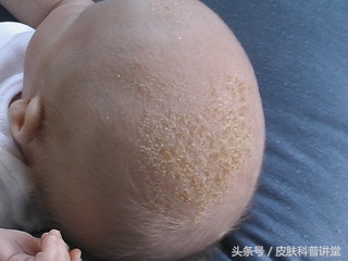 西医认为脂溢性皮炎的原因有什么,脂溢性皮炎发病年龄及发病率