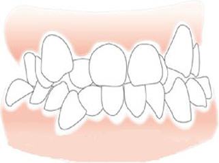 吃饭老塞牙有方法解决吗,吃饭老是塞牙能去治吗