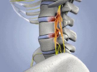 治疗颈椎病的最好理疗方法,治疗颈椎病的理疗方法