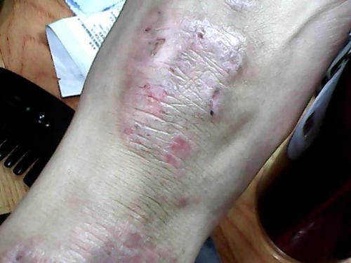 湿疹有什么草能治好,什么草治疗湿疹最有效