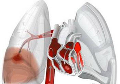 弱激光体外血液净化预防血栓，改善肺栓塞等严重情况