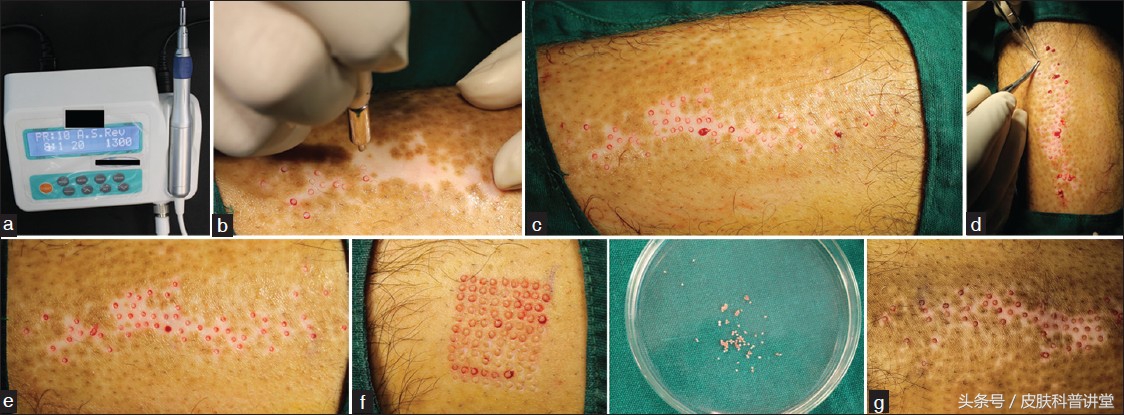 白癜风最新治疗方法录音,白癜风的治疗新进展