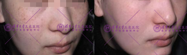 不复发黄褐斑怎么治疗,褐斑用什么治最好