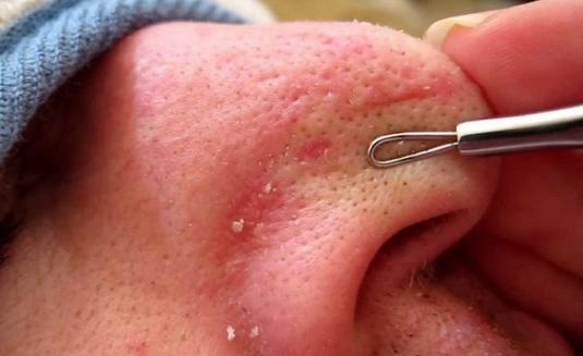 去黑头的最好办法是什么,水杨酸去黑头的正确使用方法