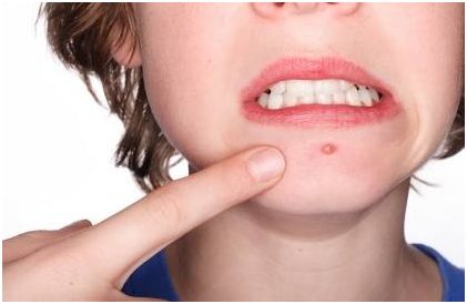 用手挤脸上的痘痘,挤脸上的痘痘会爆炸