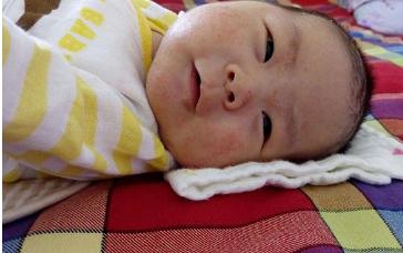 宝宝湿疹拉肚子怎么办,母乳性腹泻宝宝为什么容易有湿疹