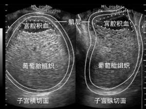 怀孕50天肚子里却没孩子,医生告知是葡萄胎?
