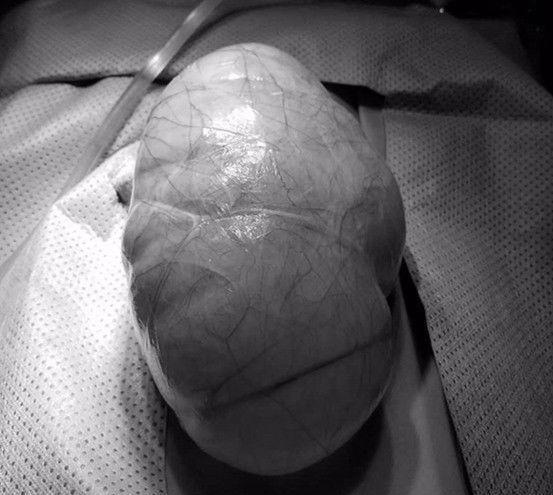 便秘折磨15年,吃不下,拉不出!原来肚里长个10斤大“皮球”